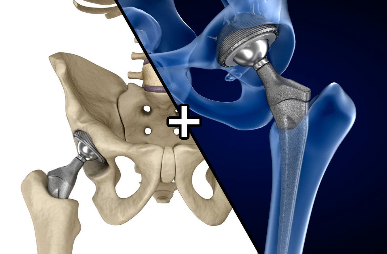 Hip Implants