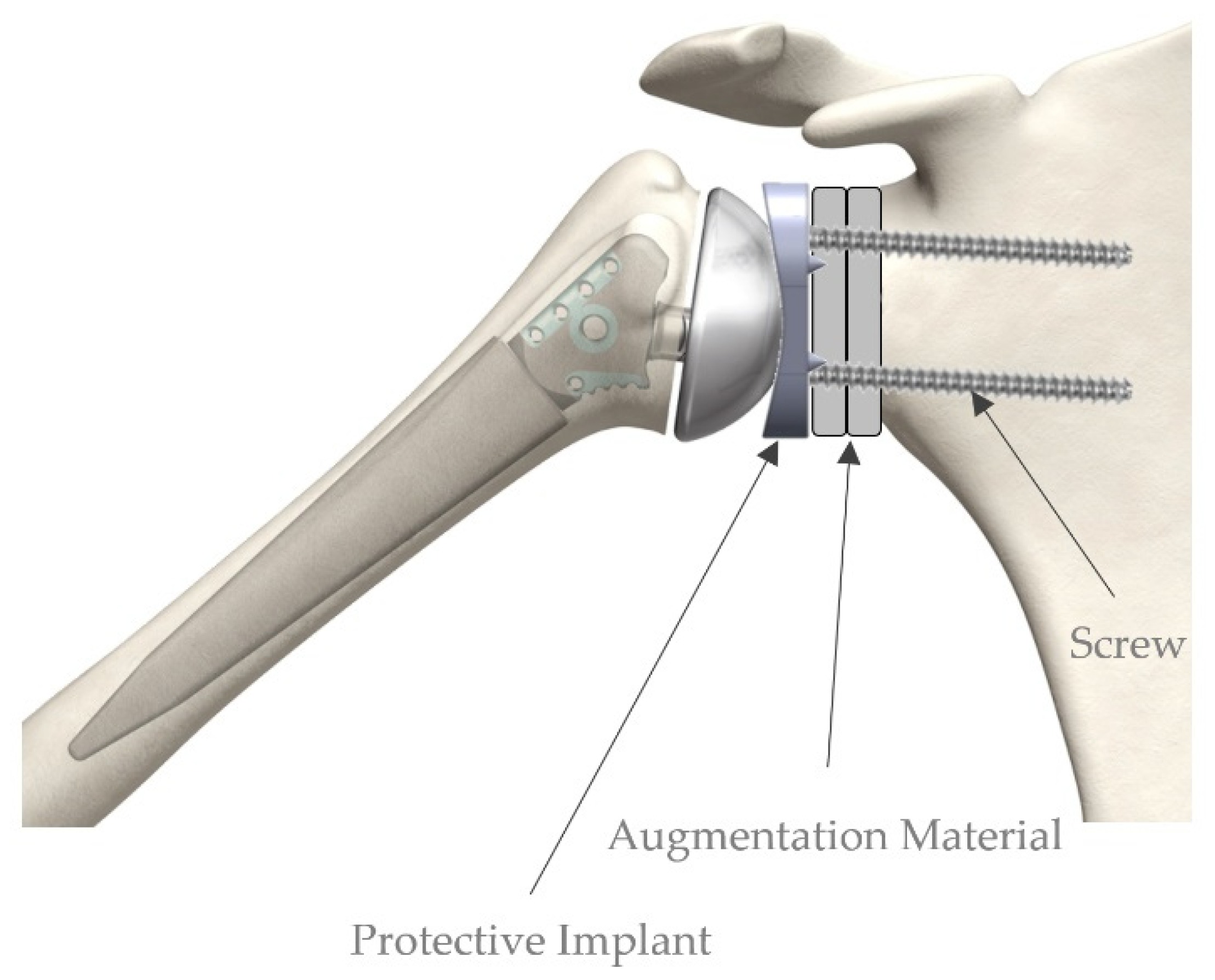 Shoulder Implants